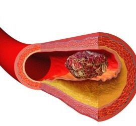 Cross-section of artery with blood clot.